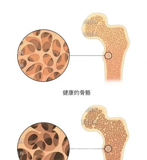 净水器使用是否导致骨质疏松（探究净水器对骨质健康的影响）